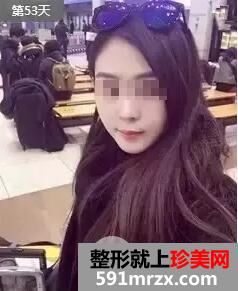 瘦脸针打几次定型