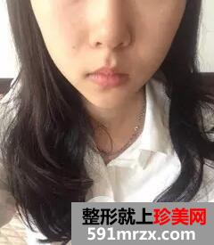 瘦脸针打几次定型