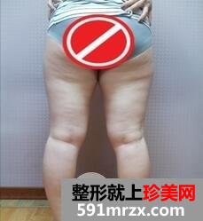吸脂塑身手术