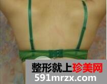 腹壁整形多少钱