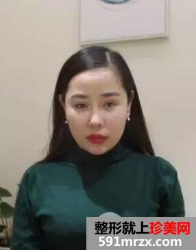 自体脂肪丰额头2