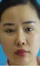 自体脂肪丰额头4