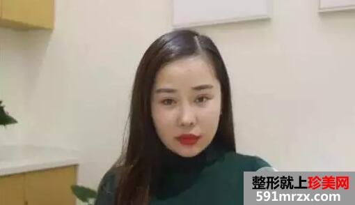 自体脂肪丰额头1