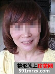 冰电波拉皮好吗1