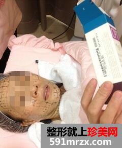 冰电波拉皮好吗4