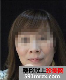 冰电波拉皮好吗8