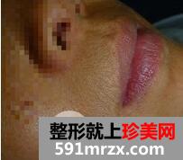 激光脱毛胡子1
