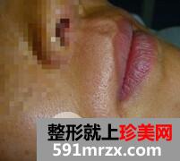 激光脱毛胡子2