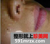 激光脱毛胡子3