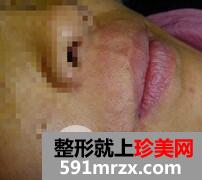 激光脱毛胡子4