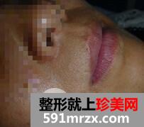 激光脱毛胡子5