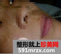 激光脱毛胡子9