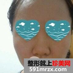 磨骨瘦脸1