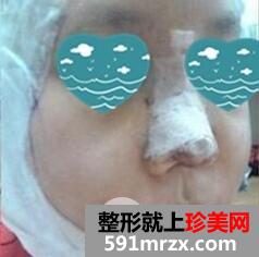 磨骨瘦脸9