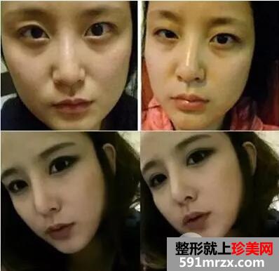 割双眼皮9