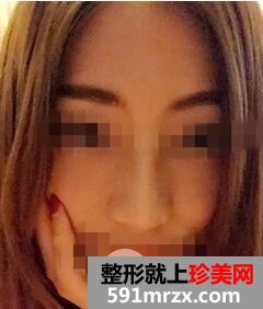 硅胶隆鼻5