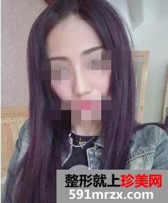 硅胶隆鼻6