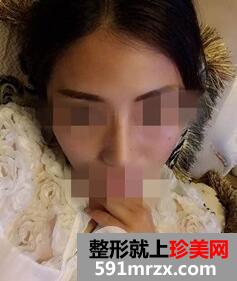 硅胶隆鼻7