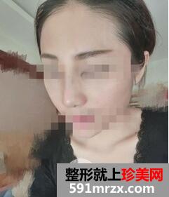 硅胶隆鼻2