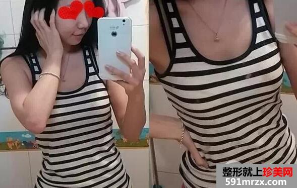 假体隆胸1