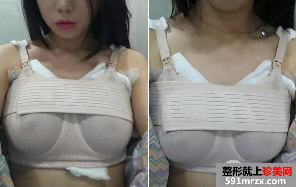 假体隆胸2
