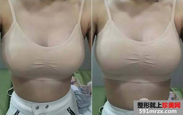 假体隆胸3