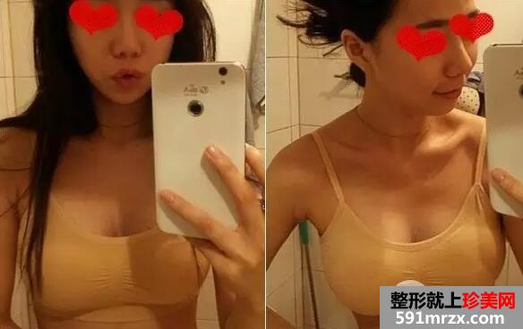 假体隆胸4