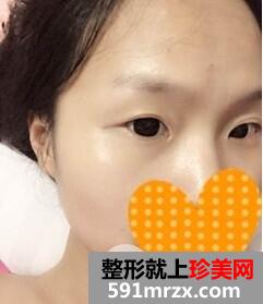 双眼皮