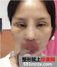 双眼皮