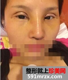 双眼皮
