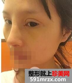 开眼角