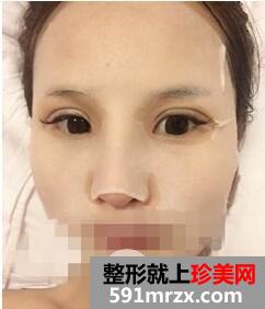 韩式翘鼻