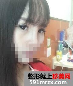 韩式翘鼻