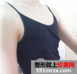 假体隆胸2
