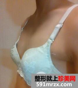 假体隆胸3