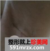 假体隆胸6