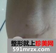 假体隆胸7