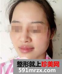 磨颧骨1