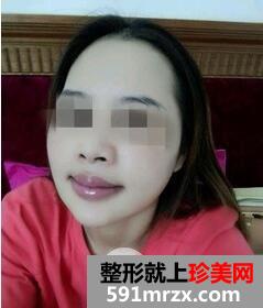 磨颧骨24
