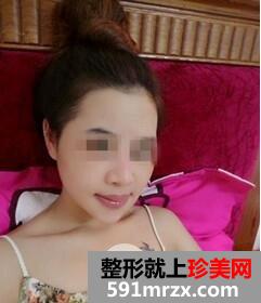 磨颧骨5