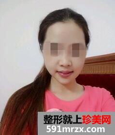 磨下颌角1