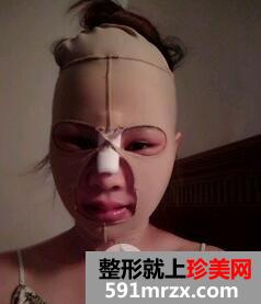 磨下颌角7