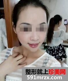 磨下颌角3