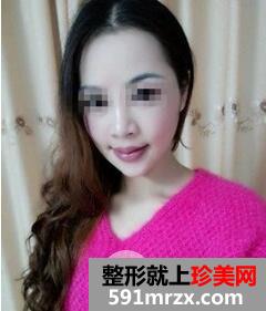 磨下颌角4