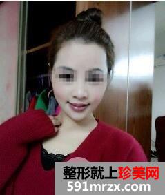磨下颌角9