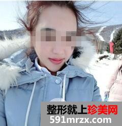 磨下颌角7