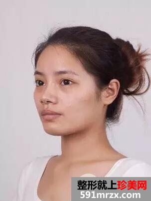 假体隆鼻手术1