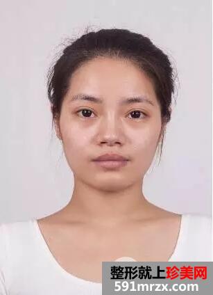 假体隆鼻手术2