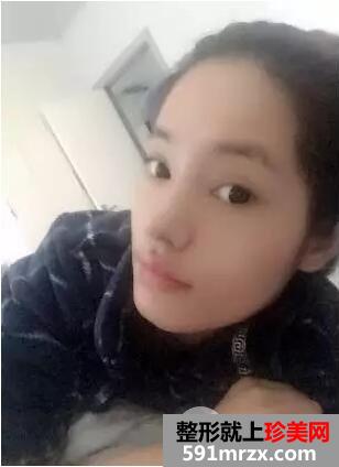 假体隆鼻手术6