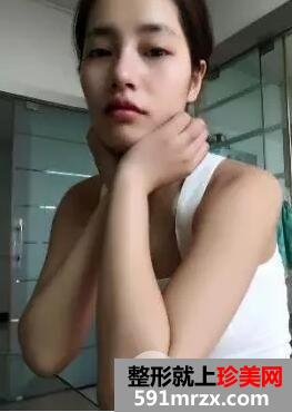 假体隆鼻手术8